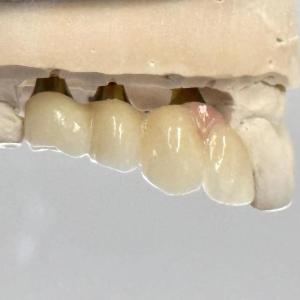 China Porcelain Zirconia Cement Retained Screw Implant Hexagonal Head Shape for Custom Fit Esthetics wholesale