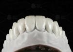 Natural Pressed EMAX Veneer Strength 16 Shades Emax Teeth Veneers