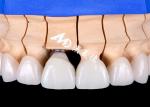 Functional Aesthetic Dental Implant Crown Bridge – Precision and Durability
