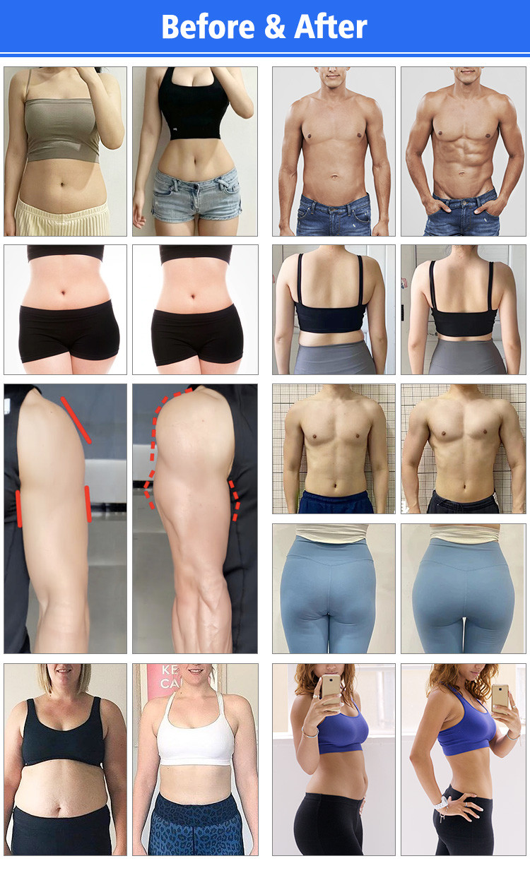 Non Surgical Butt Lift Machine AC110V-220V Body Fat Freezing Machine