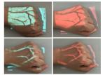 Venipucture Drawing Blood Varicosity Treatment Micro-plastic Surgery Vein