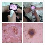 H.264 3H Continous Working 5H Charging Digital Skin Analyzer