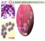 Clear Genital warts removal condyloma treatment herbal product for male sexually