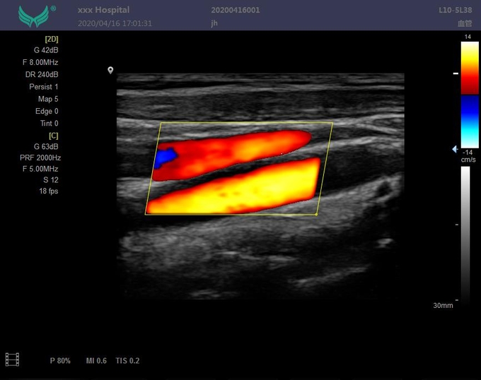 Class II Abdominal Scan Doppler Ultrasound Machine PW CFM PDI Mode 6