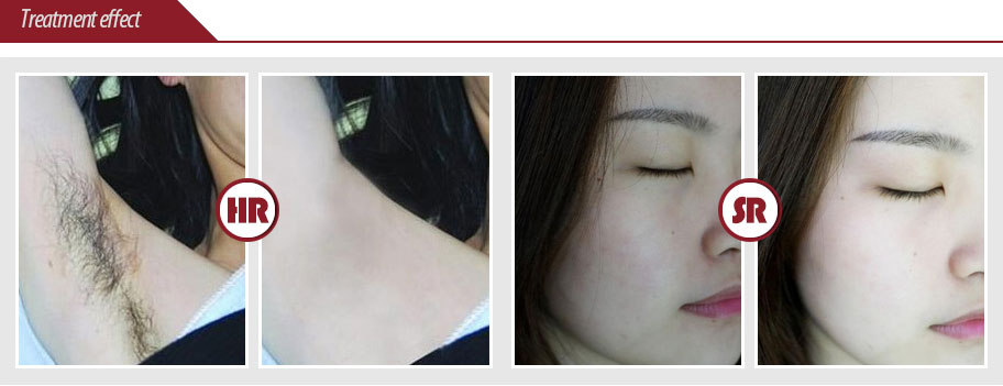 Portable Mini IPL Hair Removal Home Use Skin Rejuvenation