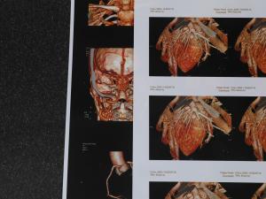 China 240gsm 180 Micron Medical Inkjet Film 3D CT Chest Film Environmental Friendly wholesale