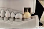 Biocompatible Dental Implant Crown And Bridge Aesthetically Pleasing For Safe