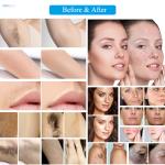 Alexandrite Commercial Yag Laser Machine For Pigment And Tattoo Removal