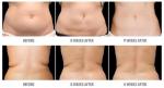 Cryolipolysis slimming equipment Cryolipolysis fat freezing slimming equipment