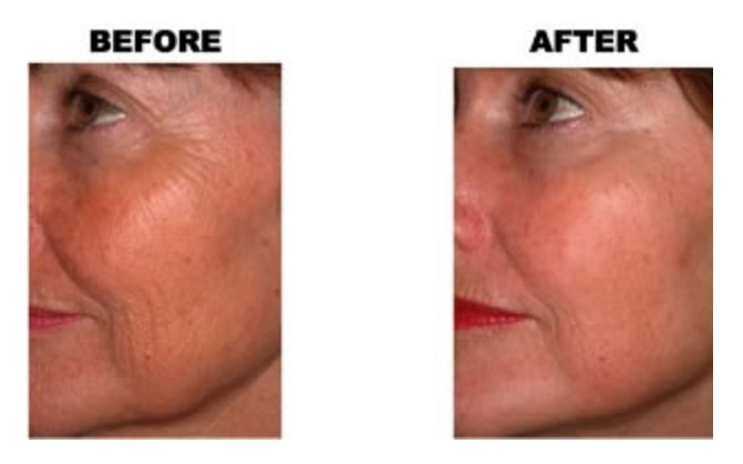 Micro CO2 Fractional Laser Machine , Fractional Carbon Dioxide Laser Resurfacing Equipment