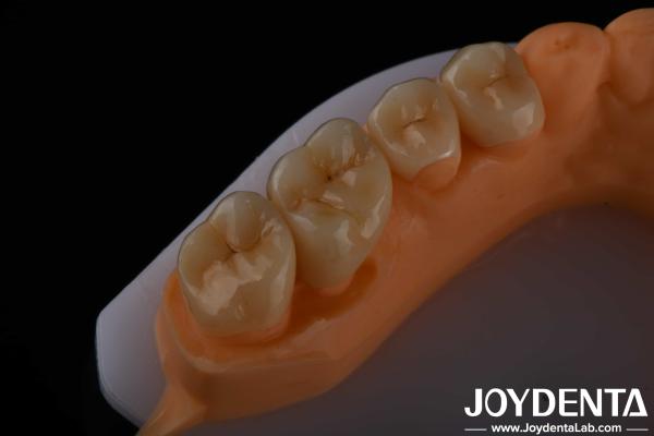 High Aesthetics Full Contour Zirconia For Crowns Bridges Implants Dental