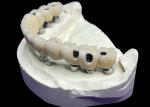 Full Arch Dental Implant Crowns and Bridges Restoring Function and Aesthetics