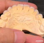 16 Shades Color Emax Dental Veneers A1-A4 High Stain Resistance For Perfectly