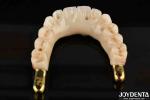 Dental Prosthesis Ti-Bar Zirconia Hybrid Bridge With High Biocompatibility