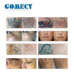 2000W Picosure Tattoo Removal Machine 100J-2000J Q Switch Nd Yag Laser Equipment