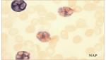 Neutrophilic- Leukocyte Alkaline Phosphatase Stain