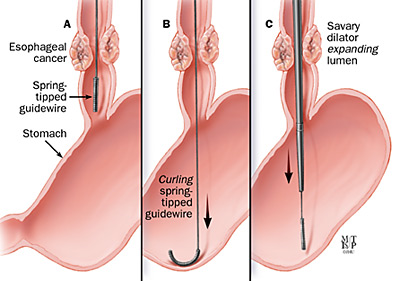 800 mm Disposable Bougie Dilator For Cardiac Stricture Treatment