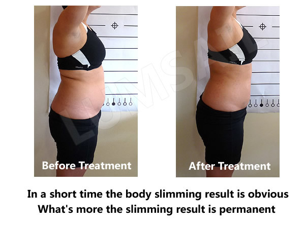 Cellulite Reduction Cryolipolysis Body Slimming Machine With High Pressure Vacuum Suction