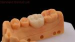 Translucency Zirconia Dental Inlay Onlay Crown For Restore Natural Cavity Shape