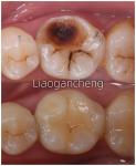 Porcelain Dental Inlay Restorative For Adults And Children Exceptional