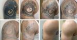 1064nm 532nm Q Switched ND Yag Laser Tattoo Removal Machine For Laser Genesis