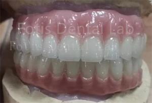 China Precise Fit Ivoclar Teeth Acrylic Complete Denture Stain Resistant wholesale