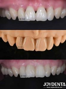 China Grassshopper Veneers The Perfect Solution For Natural Translucency Dental Veneers wholesale