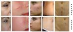 Home Laser Beauty Machine / Hair Removal Machine For Remove Scar