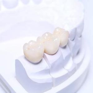 China Smooth Surface Removable Partial Dentures PFM Dental Bridge High Quality Assurance wholesale