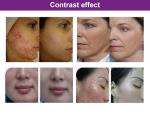 PDT 3 Color LED Light Therapy Machine For Skin Rejuvenation Red Spots Acnes