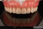 Acrylic Teeth Finish Lightweight Resin Material Dental Restorations Tooth