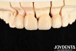 High Translucency Layered Zirconia 3 W/mK Thermal Conductivity For Exceptional
