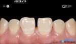 Secure Fit Porcelain Veneers Dental Treatment Composite Resin Veneers Stain