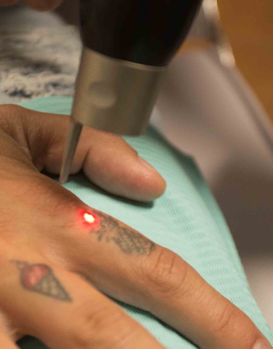 Powerful Portable ND Yag Laser Tattoo Removal Machine High Performance