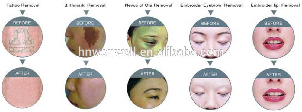 protable Q.switch Nd.yag laser machine for tattoo removal