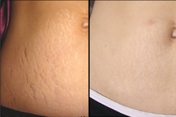 Fractional Co2 Laser Skin Resurfacing Machine For Stretch Marks Elimination