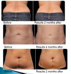 Reduce Body Sincoheren Vacuum Cavitation Slimming Machine