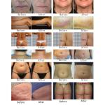 4 In1 Hair Removal Diode Laser Tattoo Removal Q Switched Nd Yag Laser 755 808