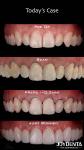 Perfect Fit Porcelain Teeth Veneers Natural Transparency Dental Laminate Veneers