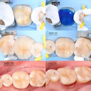 China Experience The Precision Of Dental Inlay Affordable And White For Perfect Fit wholesale