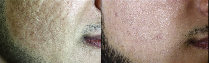 Sealed Off Fractional Co2 Laser For Acne Scars , Carbon Dioxide Laser Resurfacing Machine
