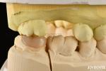 Easy Clean Emax Inlays And Onlays Hypoallergenic Biocompatible Dental Restoratio