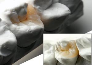 China Natural Looking Ceramic Inlays and Onlays for Precise Dental Restoration from Our Expert Dental Lab wholesale