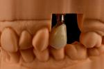 Titanium Single Tooth Dental Implants Internal Hex Connection Type For Optimal